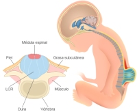 espina-bifida-junta